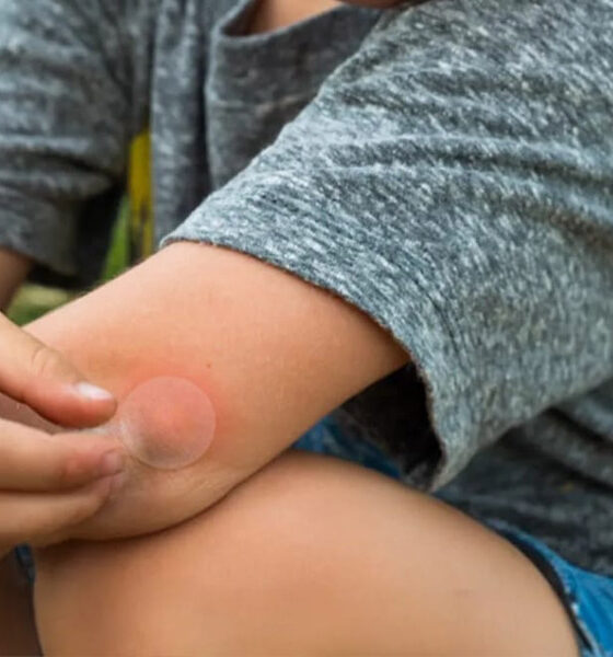 What to Put on Mosquito Bites for Fast, Steady Relief
