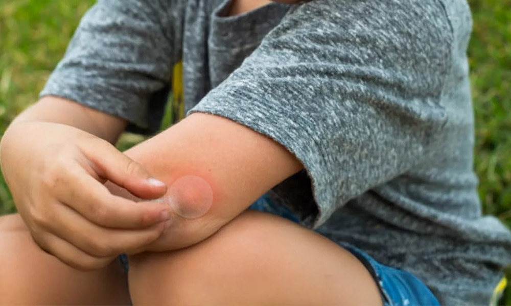 What to Put on Mosquito Bites for Fast, Steady Relief